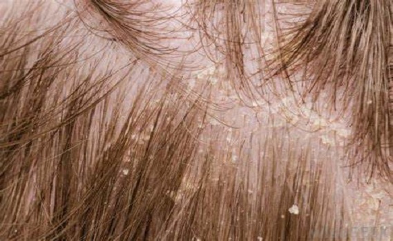 Hair and Scalp Problems Treatment in Lucknow | Scalp Problems Doctor in  Lucknow - Dr. Shafali Yadav